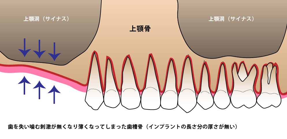 骨が足りない場合 埼玉県狭山市 インプラント治療 インプラント専門サイト